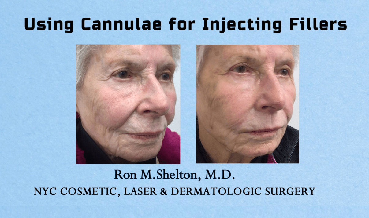 injecting-fillers-with-cannula