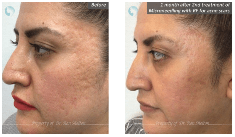 how to remove acne scars in nyc