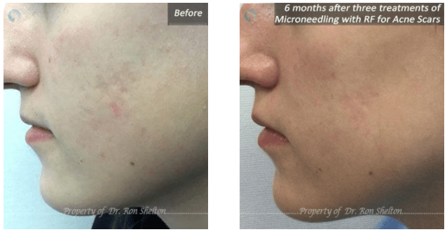 acne scars reduction nyc