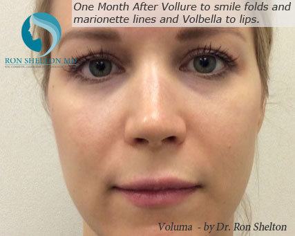 12 Days After Voluma to Upper cheeks, Vollure to smile folds and marionette lines and Volbella to lips