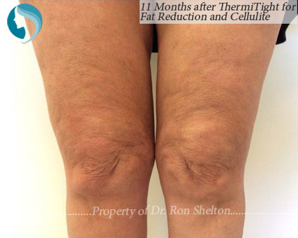 Subtle improvement above the knee for cellulite and fat reduction on knee 11 months after ThermiTight