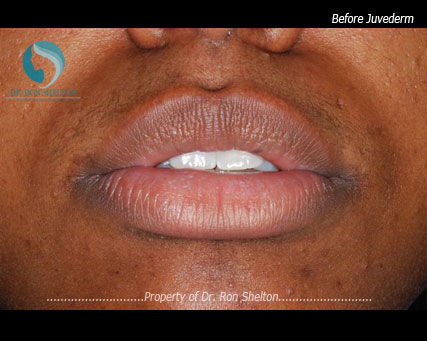 Lips Before Juvederm