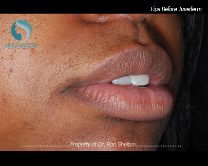 Lips Before Juvederm