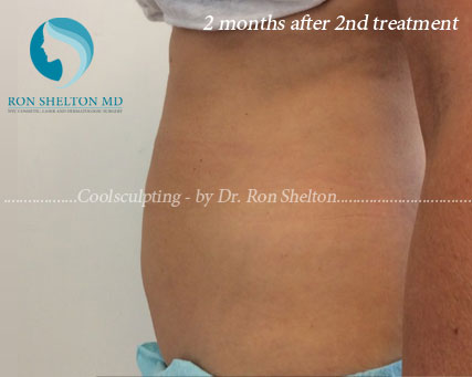 2 Months After 2nd Coolsculpting Treatment