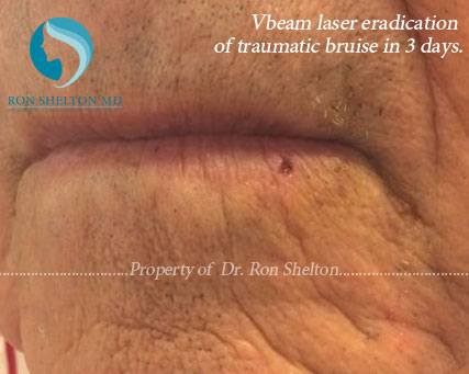 Vbeam laser eradication of traumatic bruise in three days