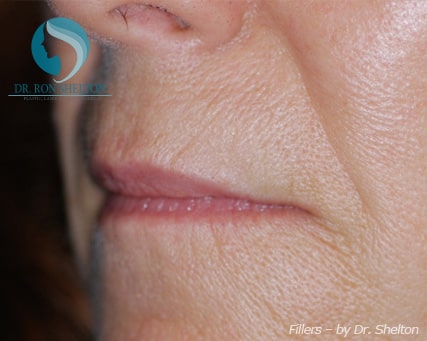 Lip lines and smile folds before Juvederm