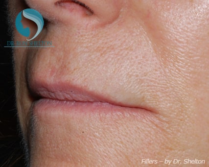 Lip lines and smile folds after Juvederm