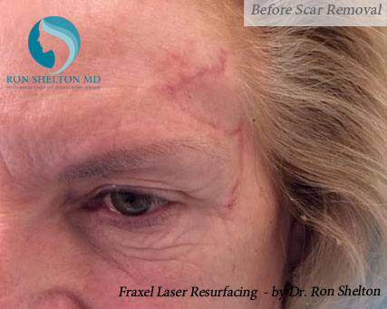 Before Scar Removal