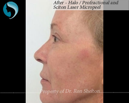 After - Halo / Profractional and Sciton Laser Micropeel