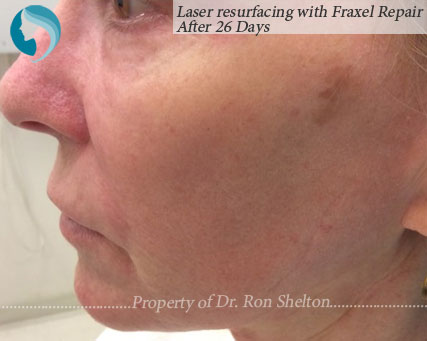 26 Days after Laser resurfacing with Fraxel Repair, CO2