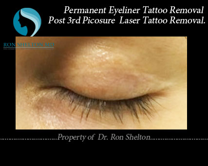 Completely resolved permanent eyeliner tattoo