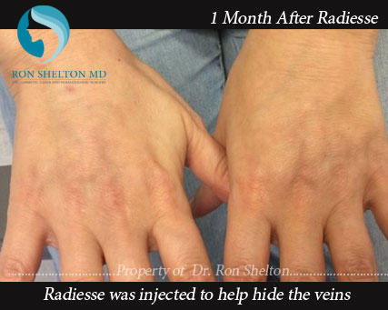 1 Month after Radiesse Treatment