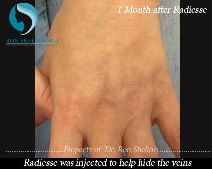 1 Month after Radiesse Treatment Radiesse was injected to help hide the veins.
