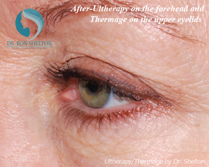 After-Ultherapy on the Forehead and Thermage on the Upper Lids