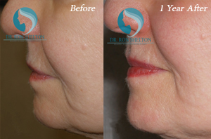 Ultherapy Treatment New York and Skin Improvement in Manhattan, NY