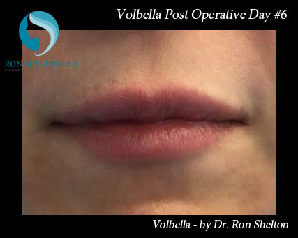 Volbella Post Operative Day #6
