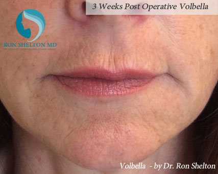 3 Weeks Post Operative Volbella