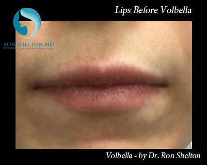 Lips Before Volbella