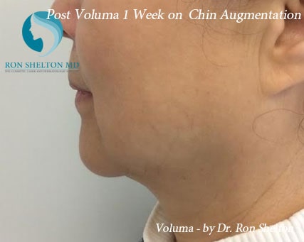 Post Voluma 1 Week on Chin Augmentation