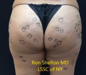 Image of Dr Ron Shelton marking the cellulite