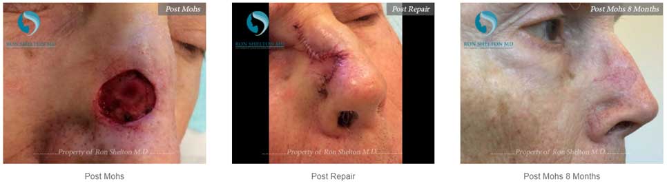 Before after treatment results of Mohs Surgery