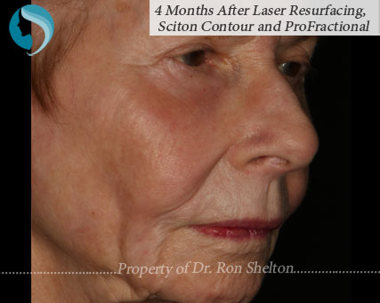 photo of 4 Months After Laser Resurfacing, Sciton Contour and Profractional