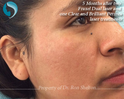 5 Months after Two treatments with Fraxel Restore/Dual laser and one Permea