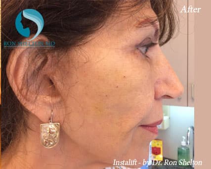 After Silhouette InstaLift Suture lift for Cheek augmentation