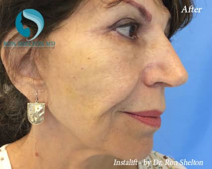 After Silhouette InstaLift Suture lift for Cheek Augmentation