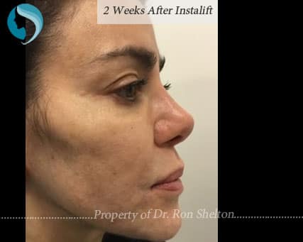2 Weeks after Silhouette InstaLift Suture Lift for Cheek Augmentation