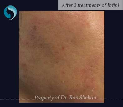 After Two Treatments of Infini Microneedling