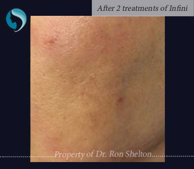 After Two Treatments of Infini Microneedling