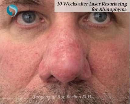 10 Weeks after Laser Resurfacing of Rhinophyma