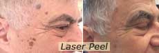 Laser Peel