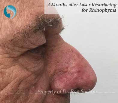 4 Months after Laser Resurfacing for Rhinophyma
