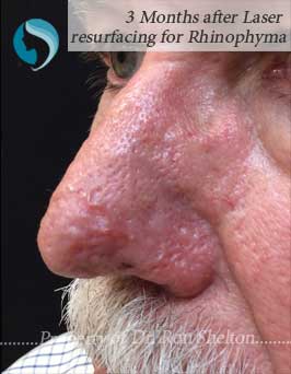 3 Months after Laser Resurfacing for Rhinophyma