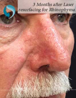 3 Months after Laser Resurfacing for Rhinophyma