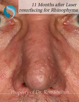 11 Months after Laser Resurfacing for Rhinophyma