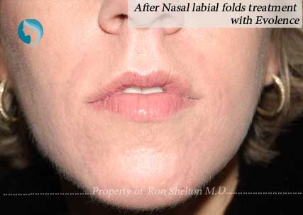 After nasal labial folds treatment with Evolence