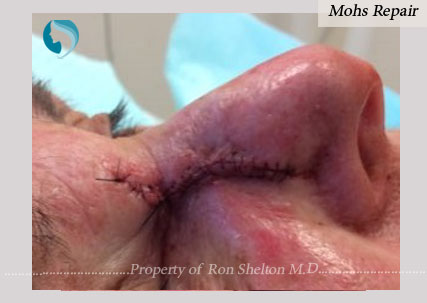 Mohs Repair by Dr Ron Shelton, NYC