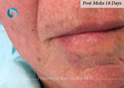 Post Mohs results after 18 days