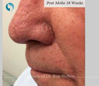 Post Mohs 18 weeks results by Dr Ron Shelton