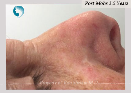 Post Mohs after 3.5 years by Dr Ron Shelton, NYC