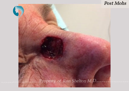 Post Mohs surgery by Dr Ron Shelton, NYC