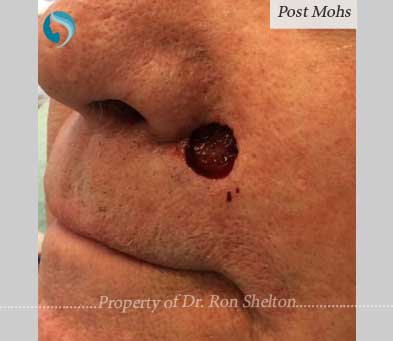 Mohs Surgery by Dr Ron Shelton