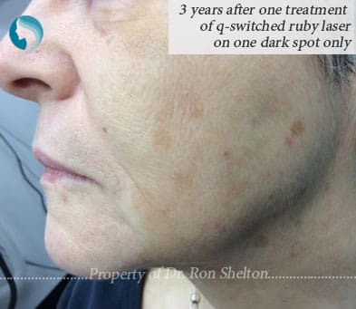3 Yrs after one q-switched Ruby Laser treatment only on one dark spot