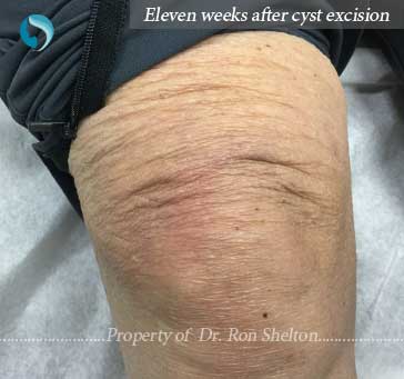 11 weeks after excision