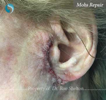 Mohs Repair by Dr Shelton, NYC