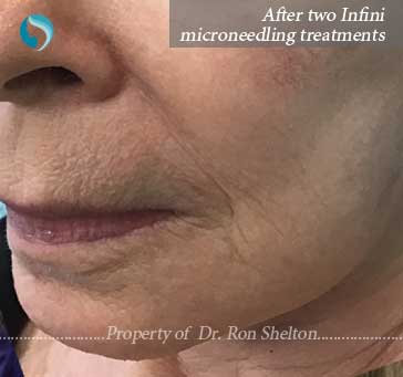 After two treatments of Infini Microneedling NYC