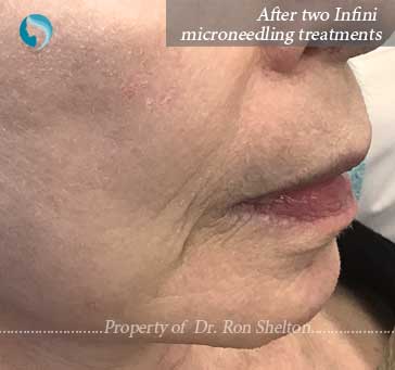 After two Infini Microneedling treatments